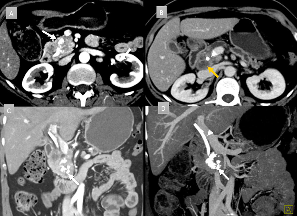 49 year old woman with pancreatic mass