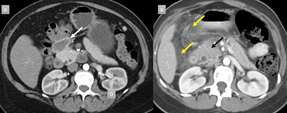 Peripancreatic masses that can calcify: Pancreatic Pseudocyst