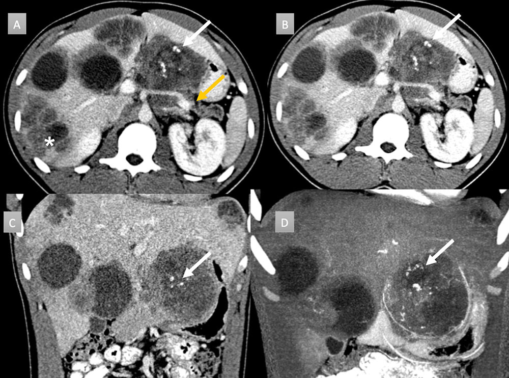 Peripancreatic masses that can calcify: Desmoplastic Small Round Cell Tumor (DSRCT)
