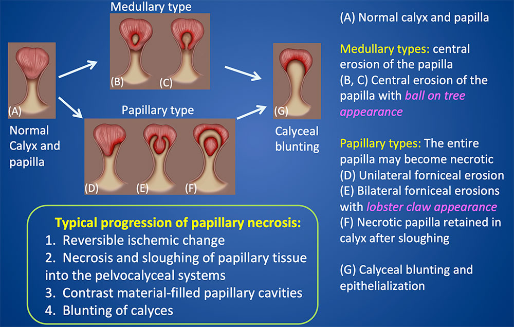Papillary Necrosis