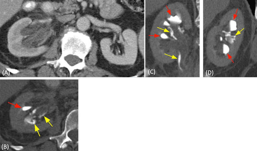 Hydronephrosis and Forniceal Rupture