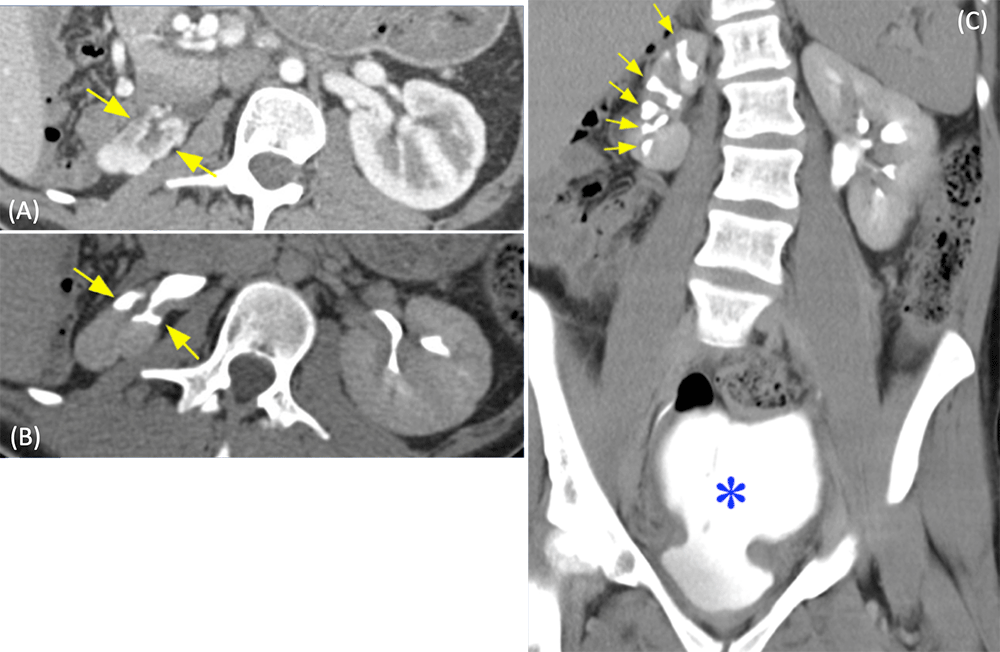 Renal Atrophy and Calyceal Clubbing