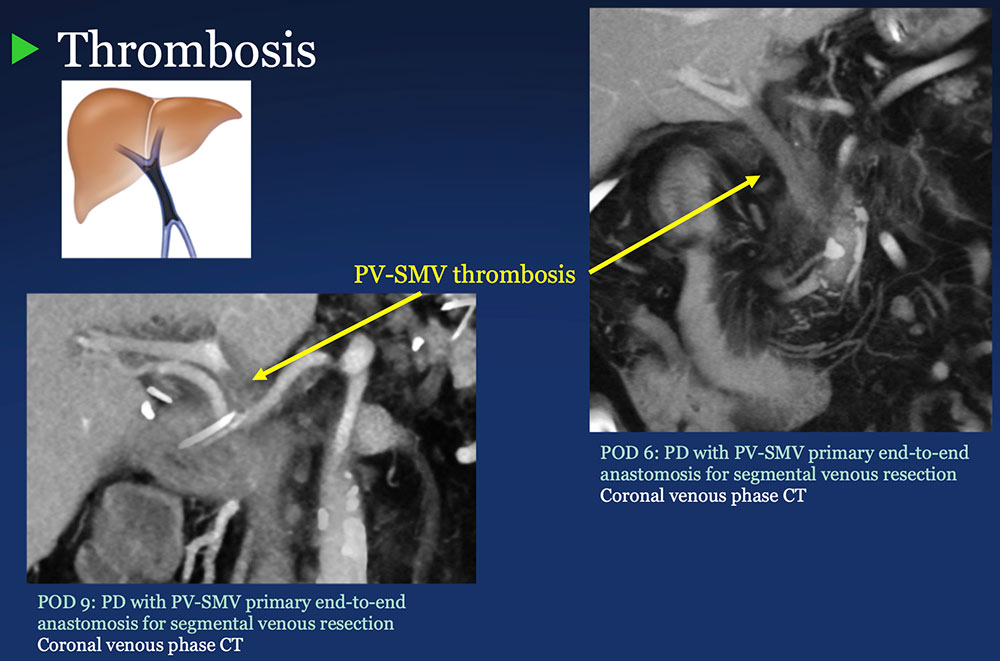 PV-SMV: Venous thrombosis on CT after PVR