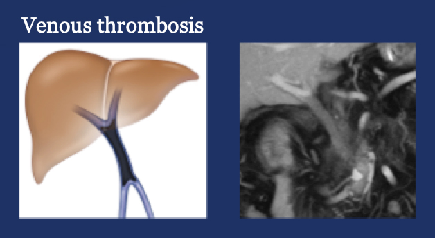 PV-SMV: Venous thrombosis on CT after PVR