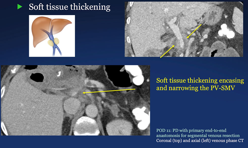 Perivenous space:  Perivenous ST thickening on CT after PVR