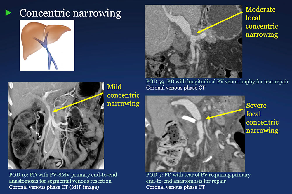 PV-SMV: Venous narrowing on CT after PVR