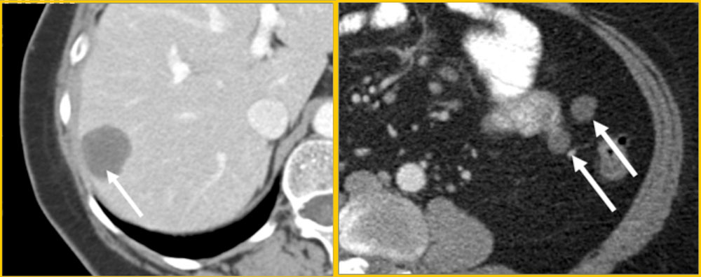 Imaging:Metastatic Disease