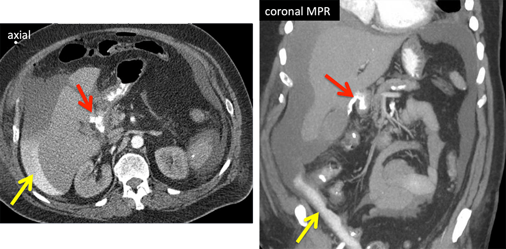 Duodenal Perforation