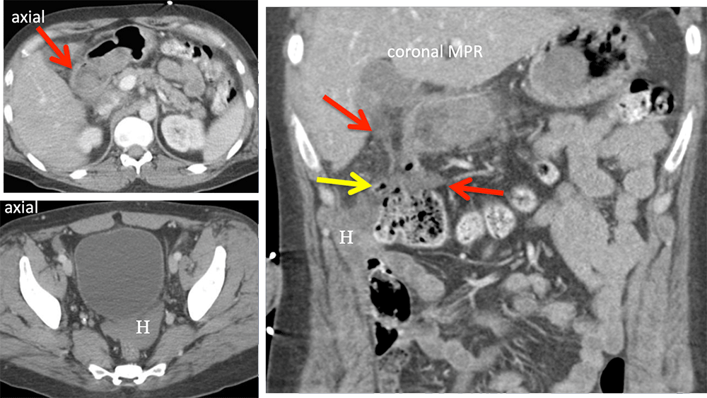 Duodenal Laceration