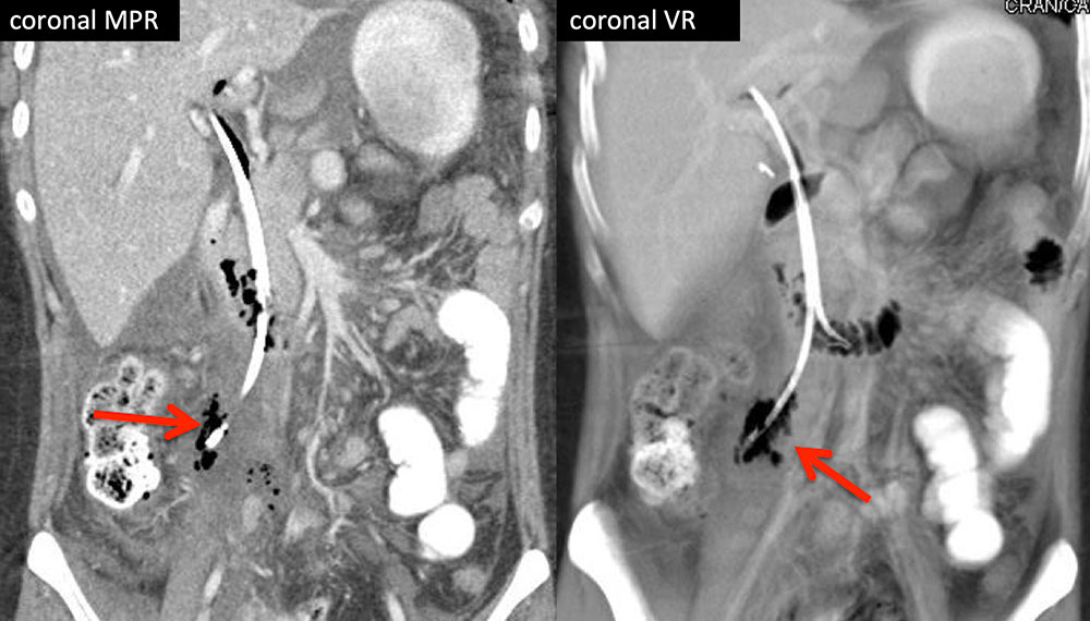 Duodenal Perforation by CBD Stent