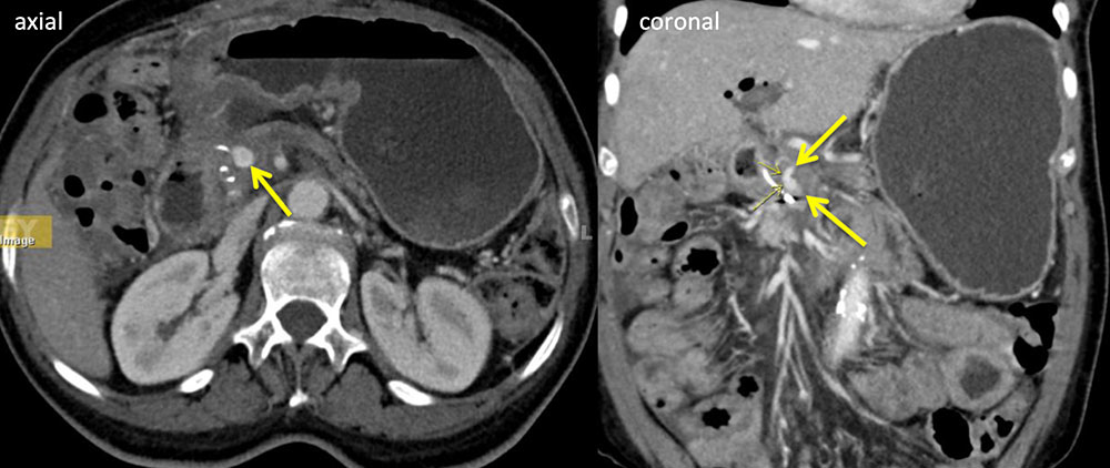 Duodenal Hemorrhage