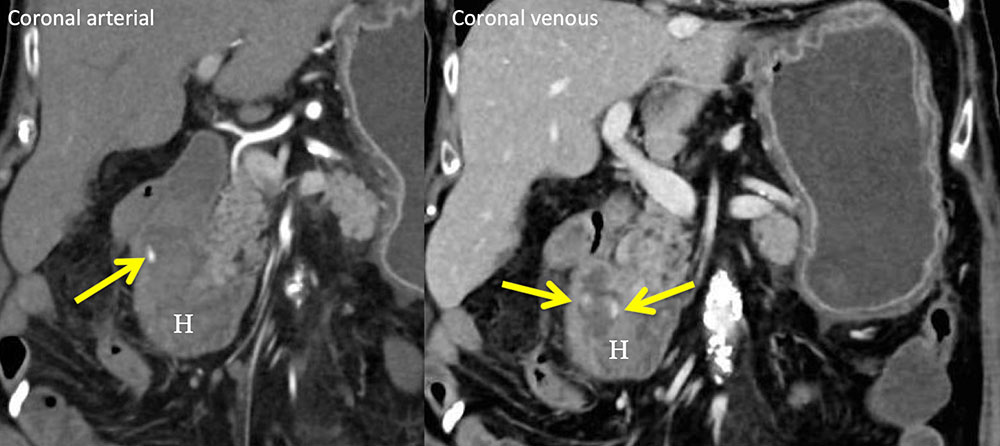 Active Hemorrhage into Duodenum