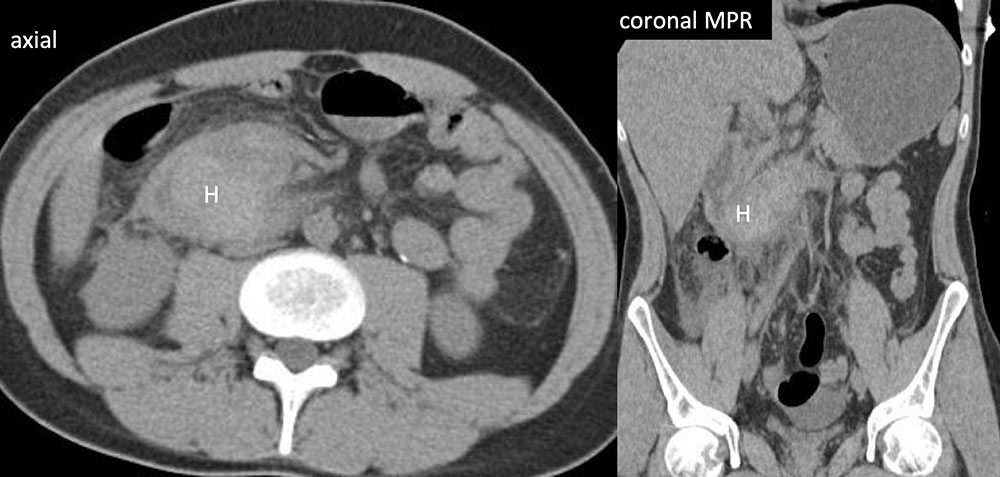 Duodenal Hematoma 