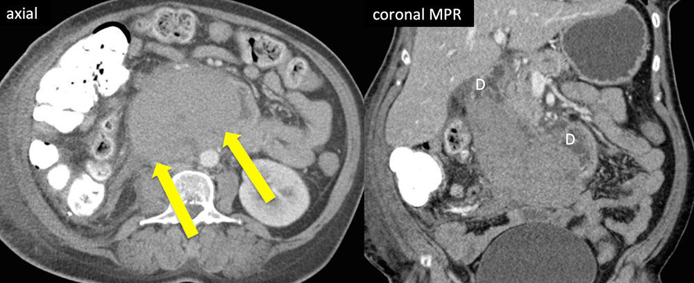 Duodenal Hematoma 