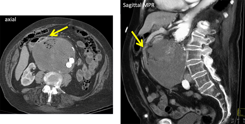 Aortoduodenal Fistula