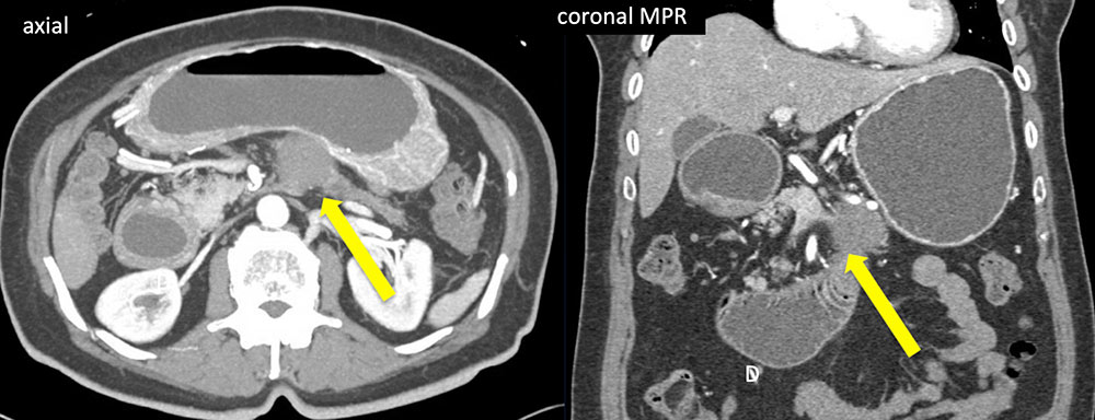 Pancreatic Adenocarcinoma