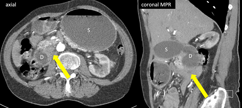 Duodenal Adenocarcinoma 