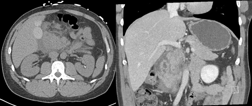 Severe Duodenitis