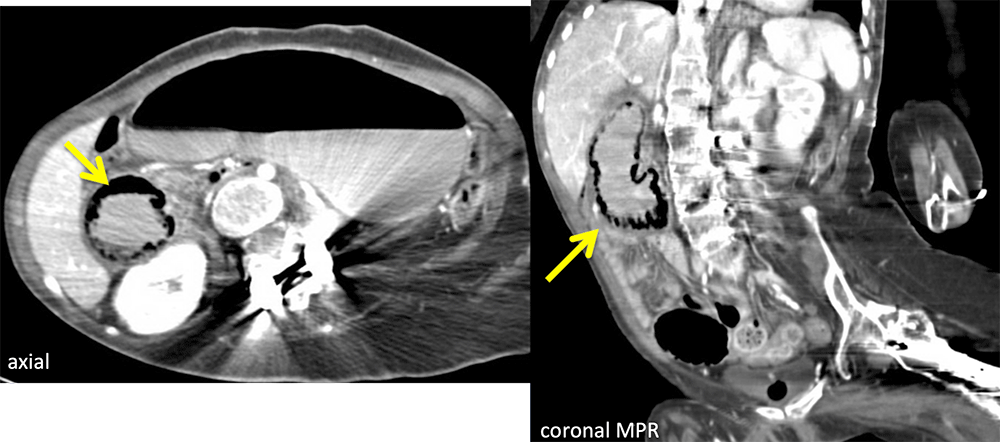 Duodenal Pneumatosis