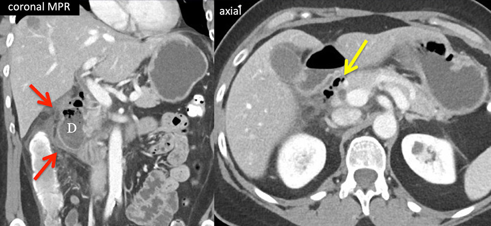 Perforated Duodenal Diverticulitis