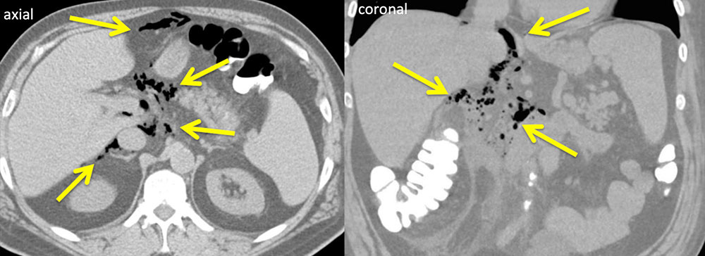 ERCP Duodenal Perforation