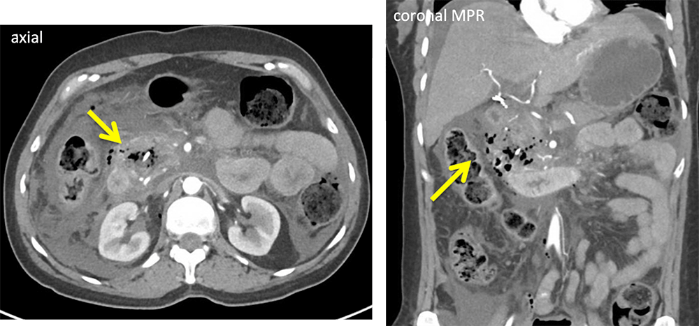 ERCP Duodenal Perforation