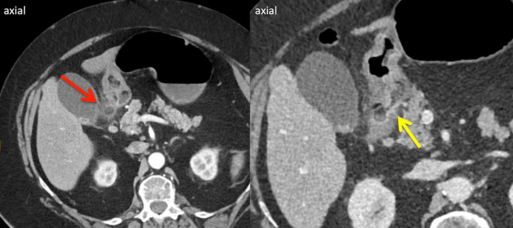 Perforated Ulcer