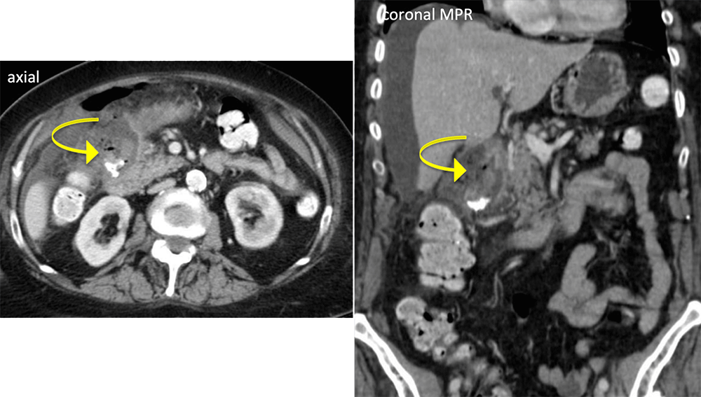 Acute Duodenal Perforation