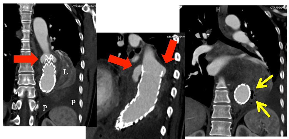 Infected EVAR and Type I Endoleak