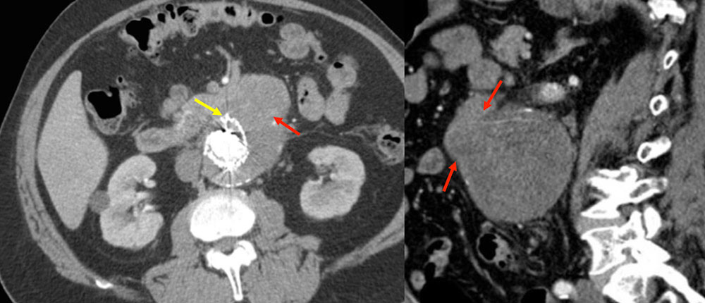 Aortoduodenal Fistula