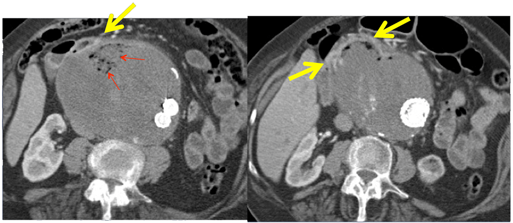 Aortoduodenal Fistula