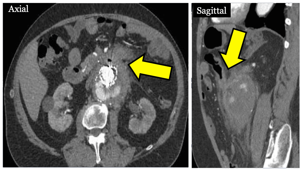 Aortocolonic Fistula