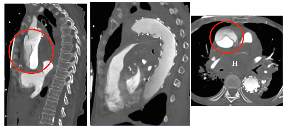 TEVAR with Retrograde Dissection