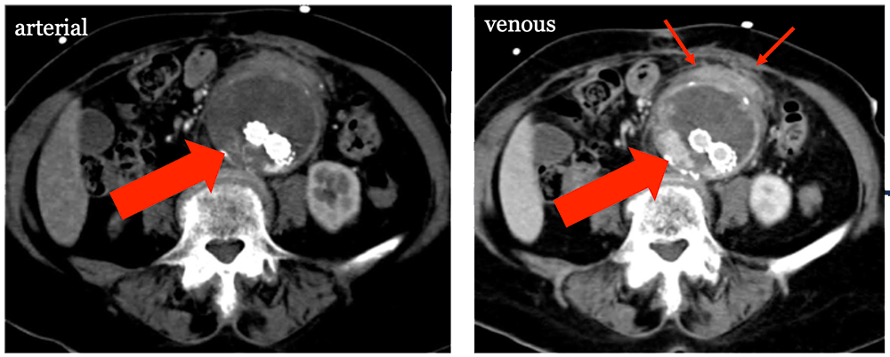 Ruptured Aneurysm Sac