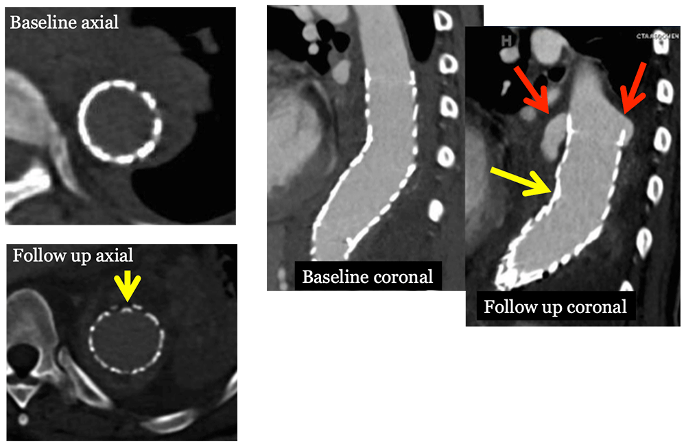 Type I Endoleak