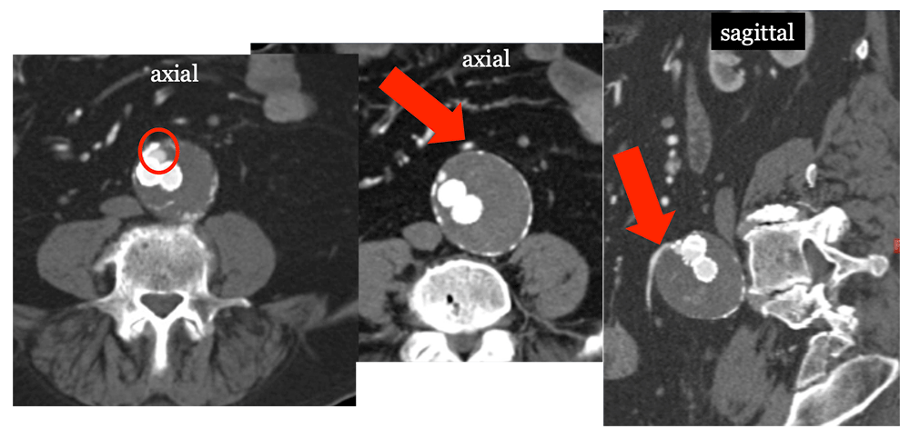 Type II Endoleak