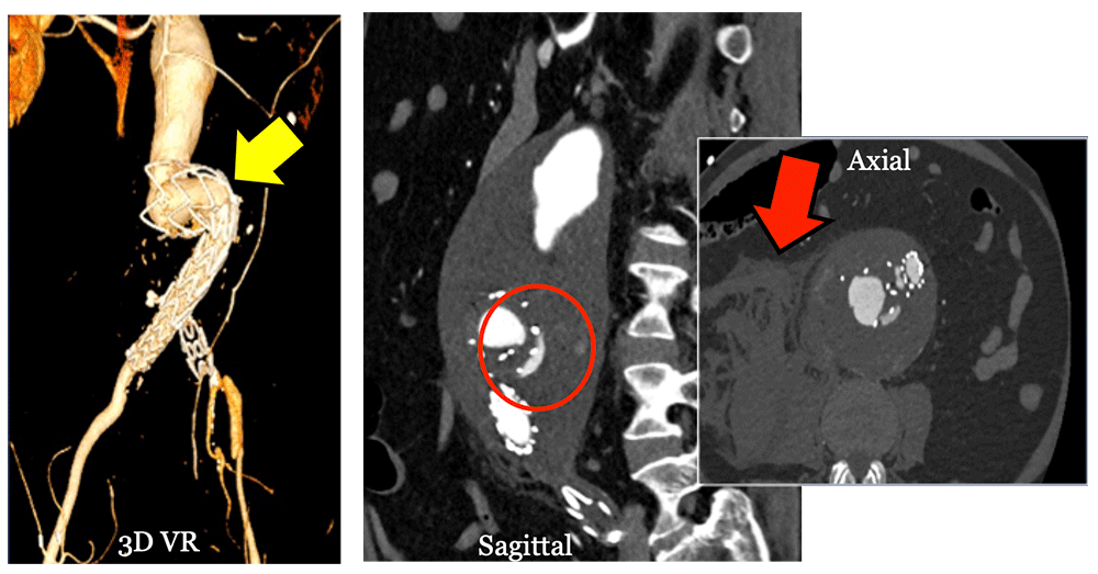 Type III Endoleak