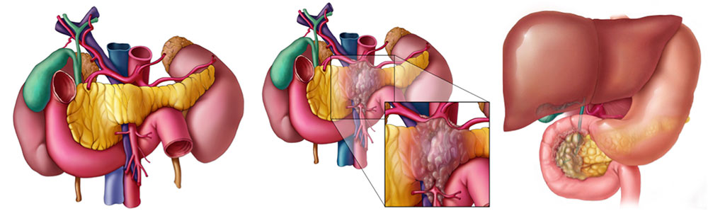 Pitfalls and Pearls in the CT Diagnosis of Pancreatic Cancer: Lessons Learned from a Weekly Multidisciplinary Conference to Improve Diagnostic Accuracy