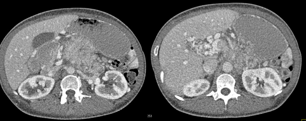 Breast Cancer Metastatic to the Pancreas Invades Portal Vein