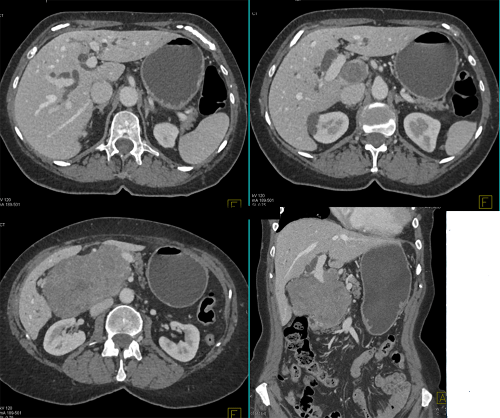 Metastatic Melanoma to Duodenum Simulates a Pancreatic Mass with Dilated CBD