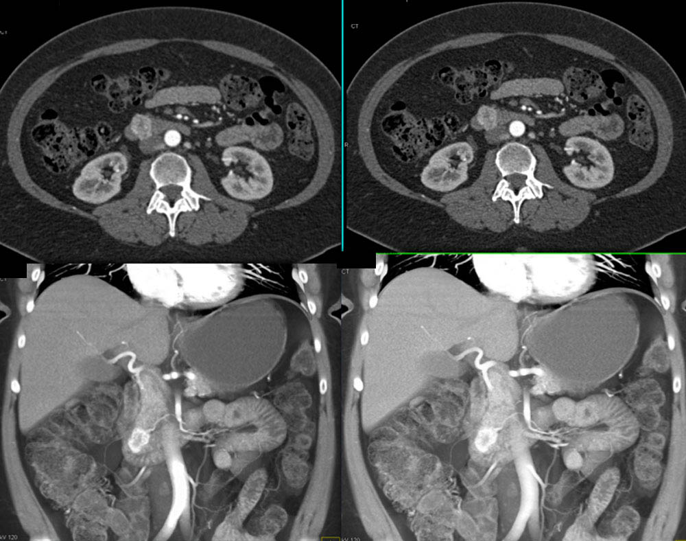 Duodenal Carcinoid Tumor Simulates a Pancreatic PET 