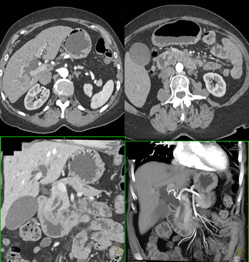 Duodenal Adenocarcinoma with Double Duct Sign