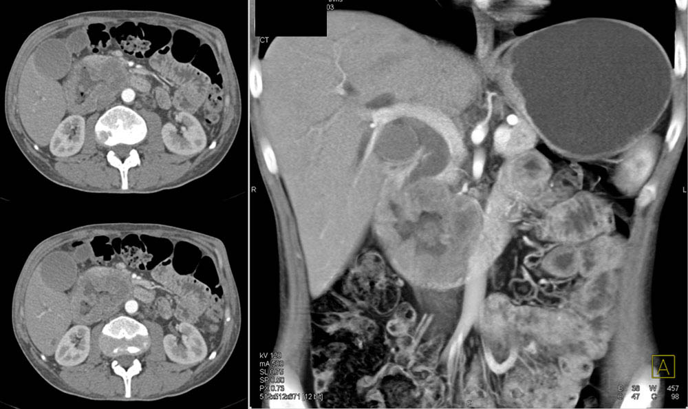 Duodenal Adenocarcinoma Simulates a Pancreatic Mass