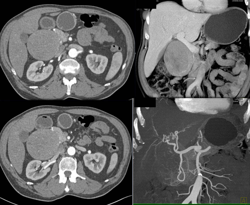 Duodenal GIST Tumor Simulates a Pancreatic Mass. Key is lack of CBD or PD Obstruction and Epicenter of Lesion