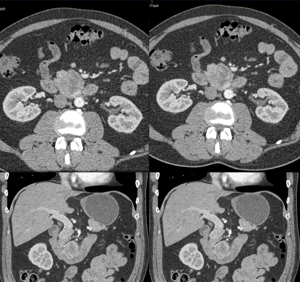 GIST Tumor Duodenum Simulates Pancreatic Mass