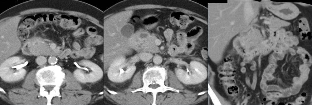 Groove Pancreatitis Simulates a Pancreatic Mass