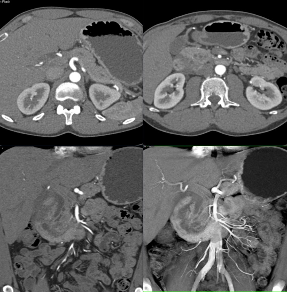 Groove Pancreatitis Simulates a Pancreatic Tumor with Dilated CBD