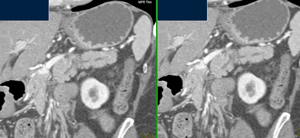 Small Pancreatic Cancer with Dilated Pancreatic Duct