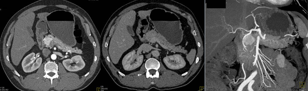 Neuroendocrine Tumor HOP Seen Only On Arterial Phase