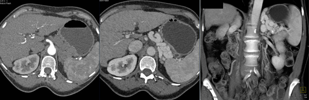 Patient Referred for a Pancreatic Tail Mass Had Varices but no Pancreatic Mass